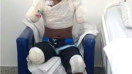 Adolescente sofre amputações após choque elétrico em Santos, SP