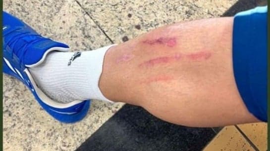 Rômulo, lateral do Cruzeiro mostra marcas na perna, decorrente de falta sofrida em jogo contra CSA