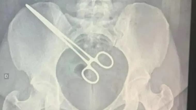 Objeto cirúrgico esquecido em paciente descoberto durante visita a presídio