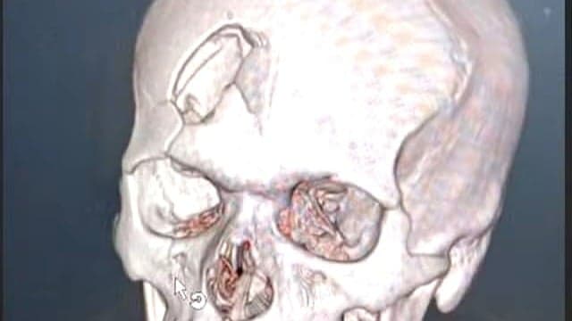 Homem sobrevive após cirurgia para retirada de estaca de madeira cravada no crânio