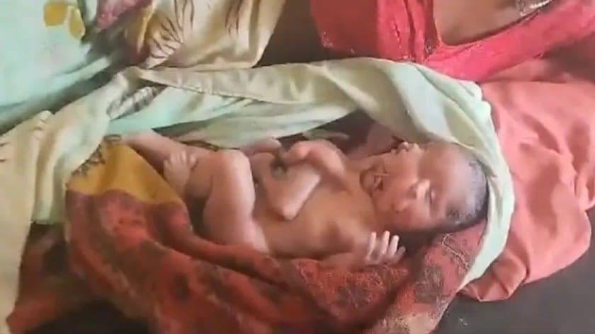 Bebê nasce com quatro braços, quatro pernas e dois rostos na Índia