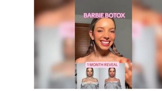 Médicos alertam sobre riscos do ‘botox da Barbie’ para movimento da cabeça