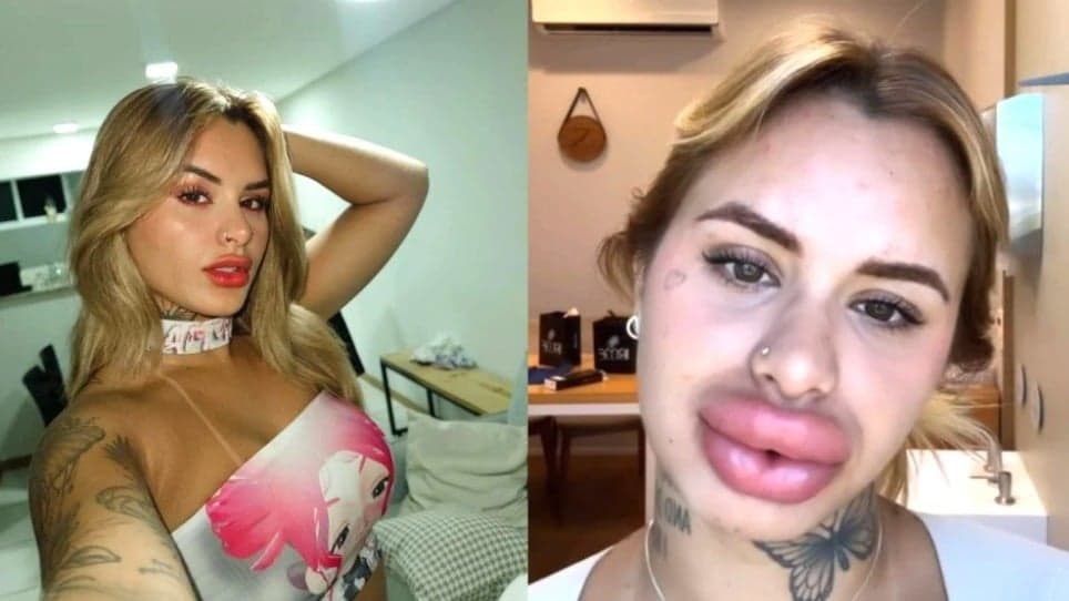 Resultado da remoção de preenchimento labial da influenciadora Nicole Reis surpreende seguidores