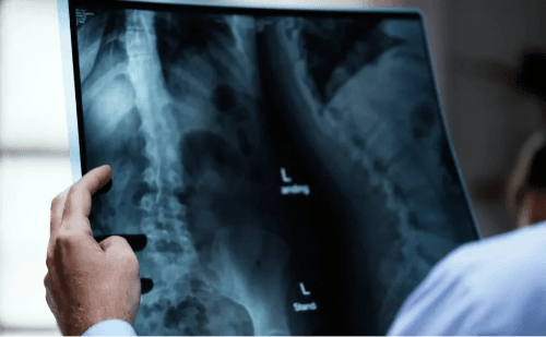 Artrose na coluna causa dores intensas e não tem cura, alertam especialistas
