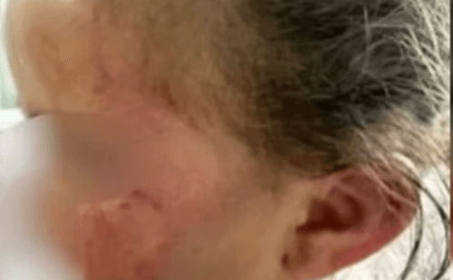 Menina de 3 anos é agredida com cabo de vassoura pela mãe
