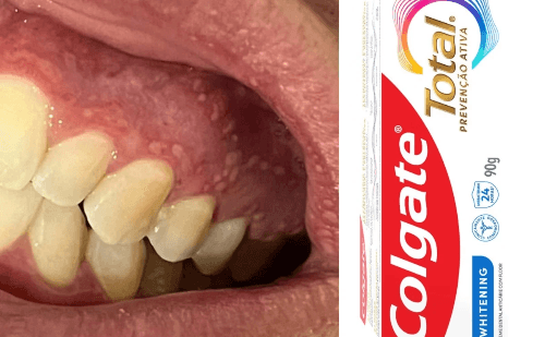 Anvisa reforça proibição de venda da Colgate Total Clean Mint