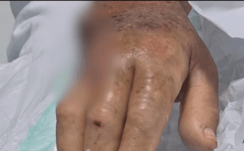 Ataques com pitbulls no RJ deixam idosa mutilada e adolescente ferida