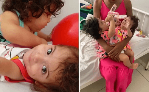 Gêmeas siamesas passam por cirurgia de separação no SUS