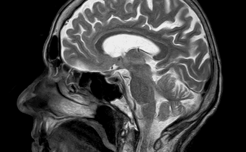 Brasileira perde fala em inglês após hemorragia cerebral na China