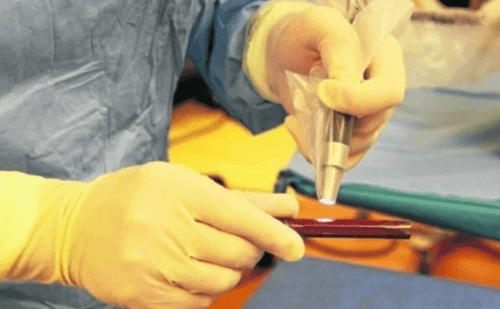 Nova prótese 3D com antibiótico pode revolucionar tratamento de infecções no Brasil