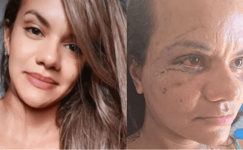 Natal: após reconstrução facial, vítima de 61 socos mostra rosto