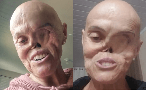 Aposentada de Itaiópolis luta contra câncer de pele raro há 27 anos