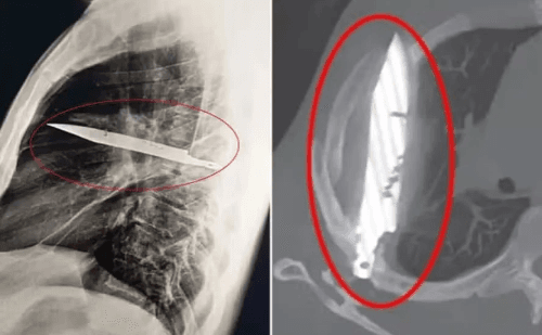 Homem vive 8 anos com faca no peito sem saber e surpreende médicos