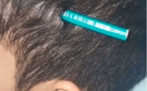 Menino de 9 anos tem lápis cravado na cabeça por colega em escola pública
