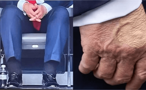 Hematomas de Trump reacendem debate sobre sua saúde circulatória