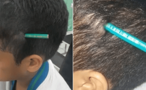 Aluno transfere de escola após agressão com lápis em Praia Grande