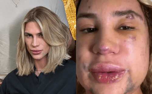 Especialista detalha riscos do 'fox eyes', técnica feita por influencer antes de morrer
