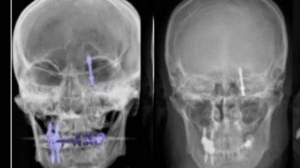Parafuso de implante dentário atravessa crânio e atinge cérebro de paciente